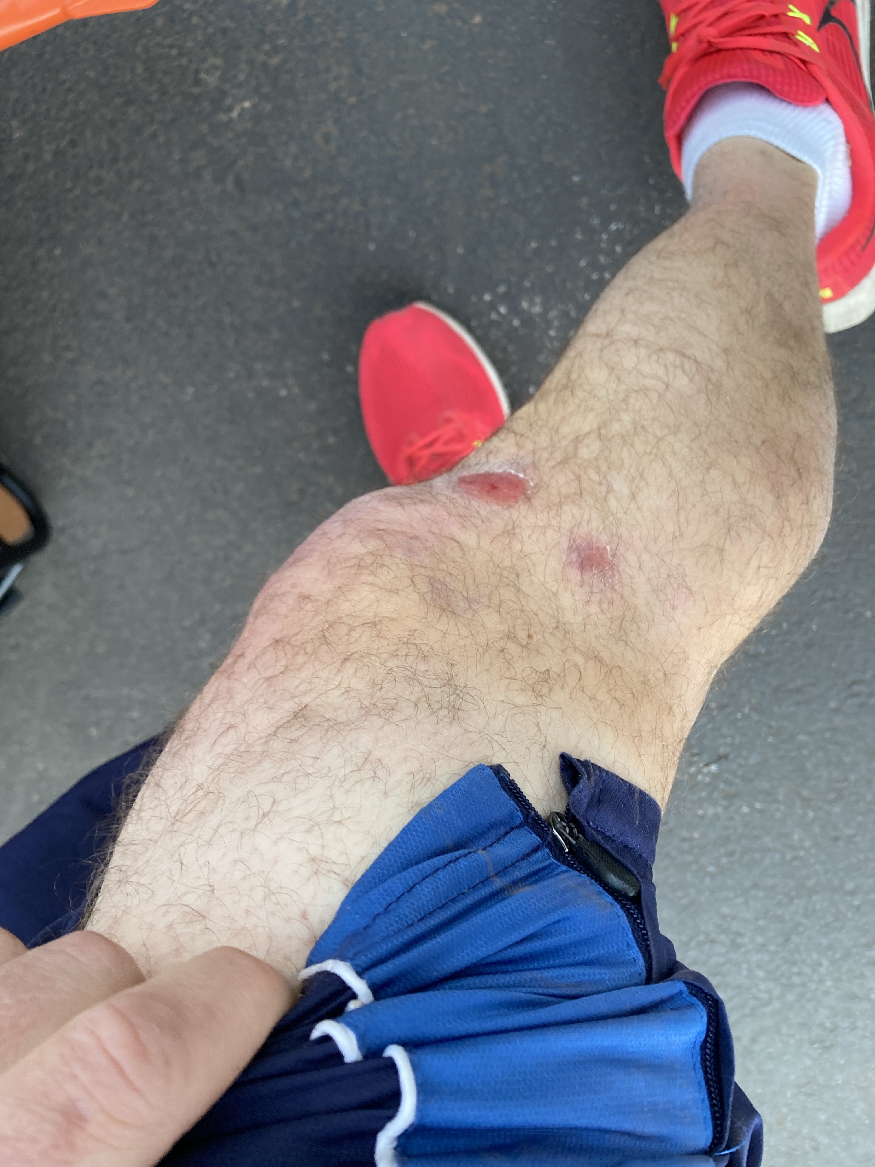 My Leg