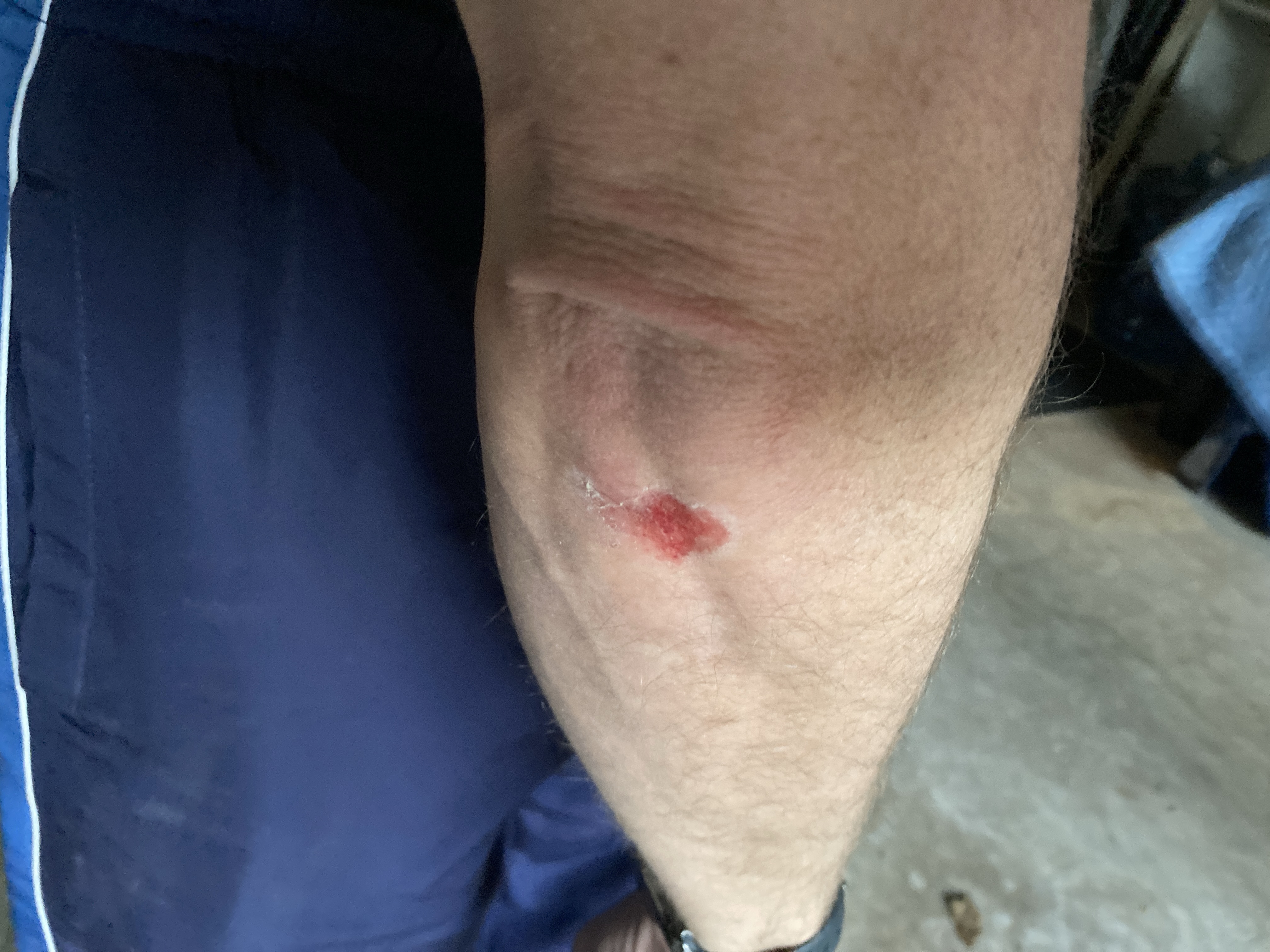 My Elbow